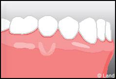 Chirurgie mucogingivale