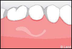 Chirurgie mucogingivale