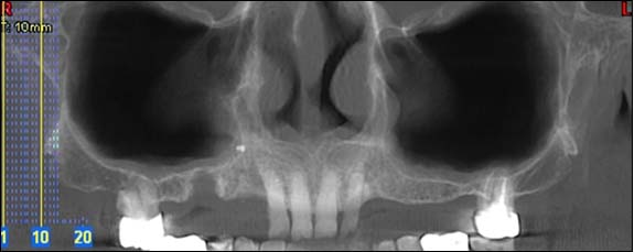 Les maladies des gencives